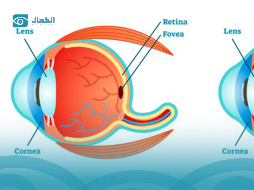 تمزق-شبكية-العين