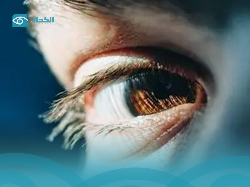 تحسس-العين-من-الضوء