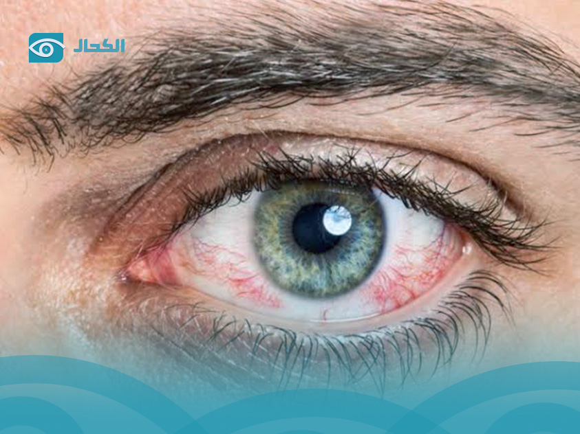 تحسس-العين-من-الضوء