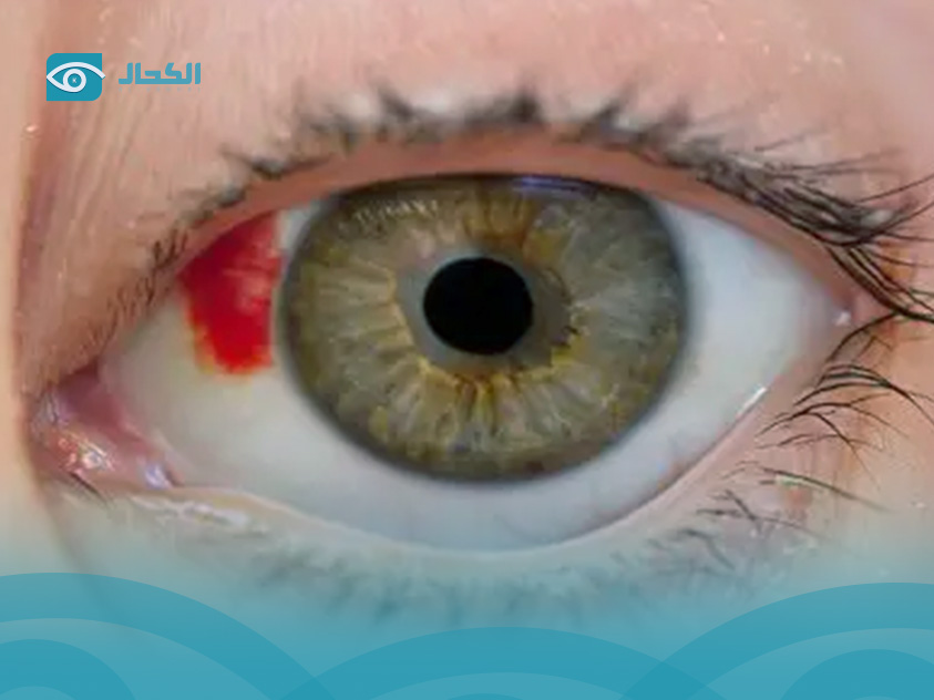 نزيف-شبكية-العين-لمرضى-السكري