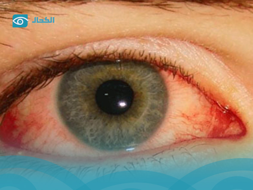 نزيف-شبكية-العين-لمرضى-السكري