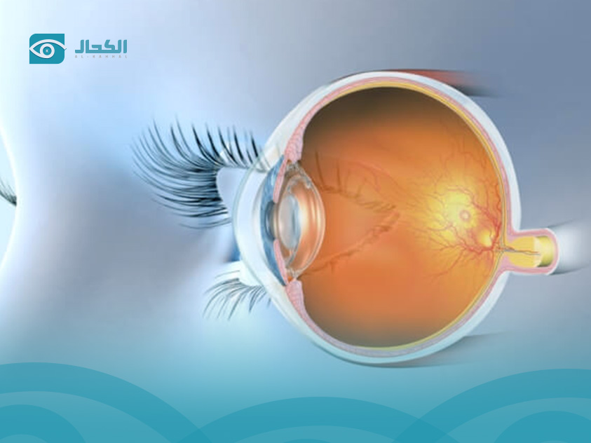 علاج-انفصال-السائل-الزجاجي-في-العين