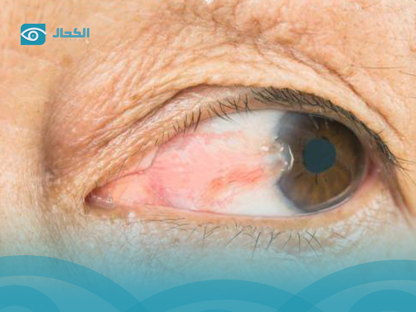 ما-هو-ظفر-العين