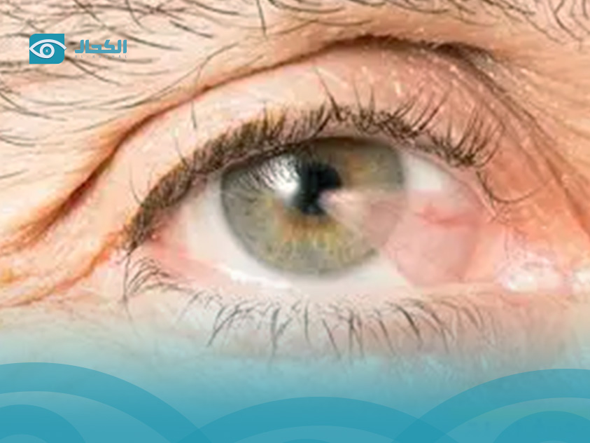 كيف-يكون-شكل-ظفر-العين