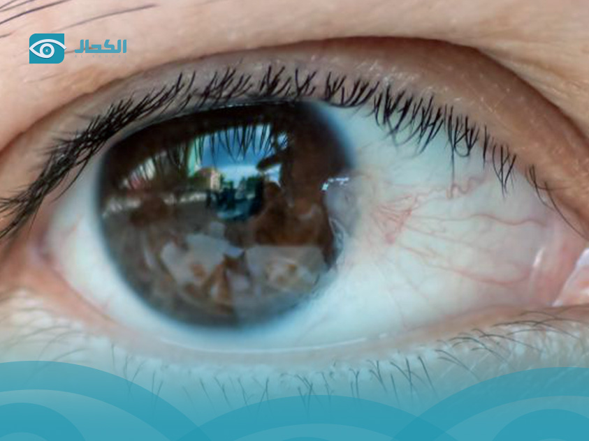 اسباب-ظفر-العين-وعلاجه