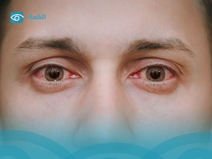 اعراض التهاب ملتحمة العين