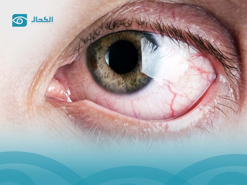 Difference Between Glaucoma and Cataract