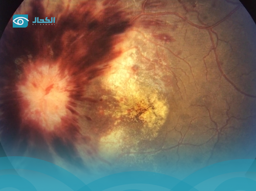 ما هي أسباب وطرق علاج ارتشاح قاع العين