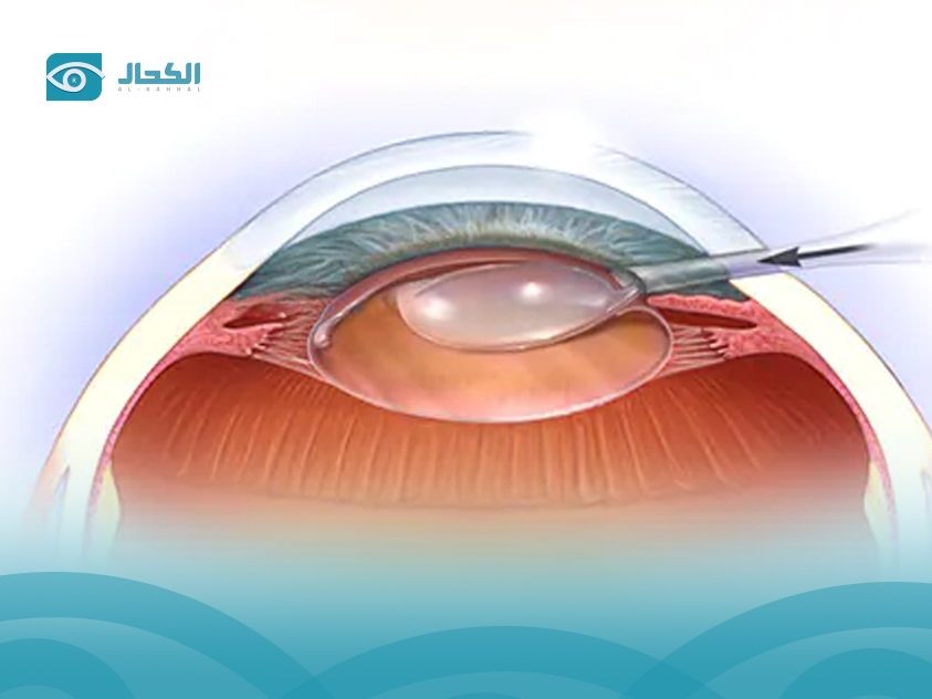 عملية- كتراكت- العين