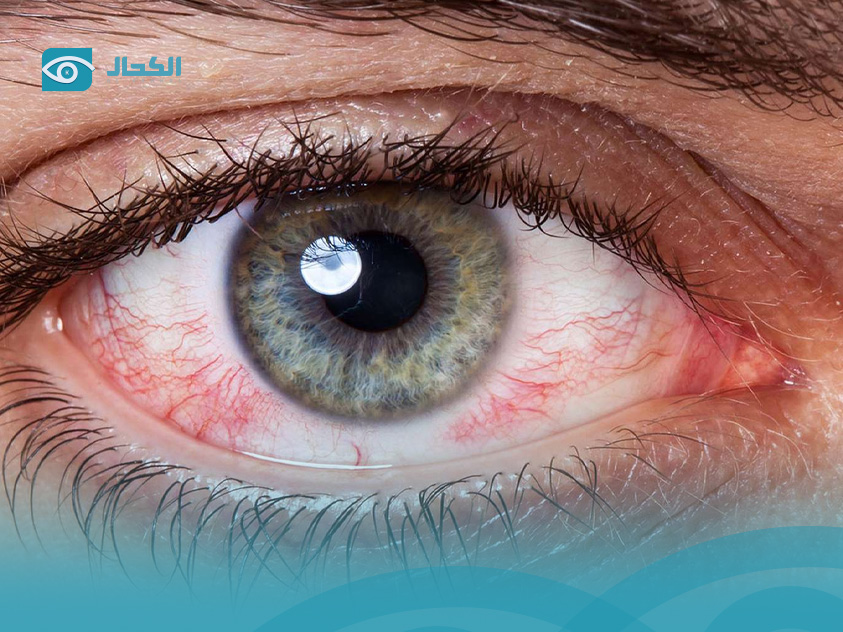 التهاب-الملتحمة-التحسسي