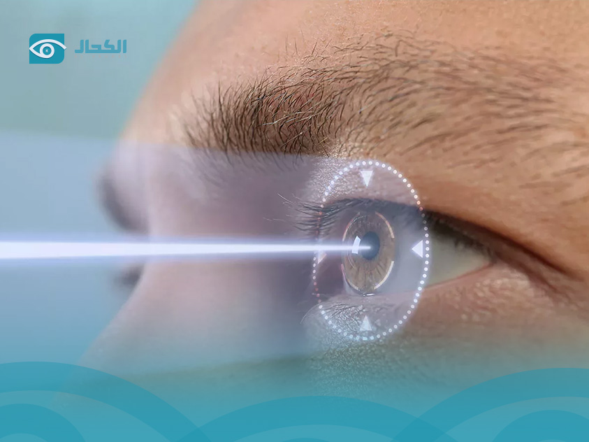 Lasik-Eye-Surgery