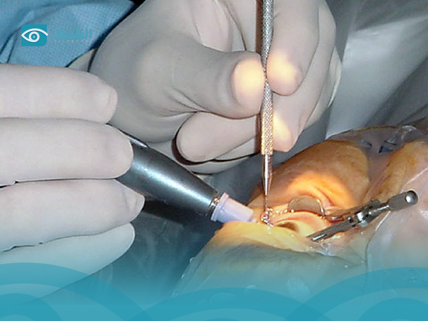 Cataract-Surgery