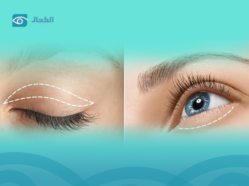 eyelid-surgery