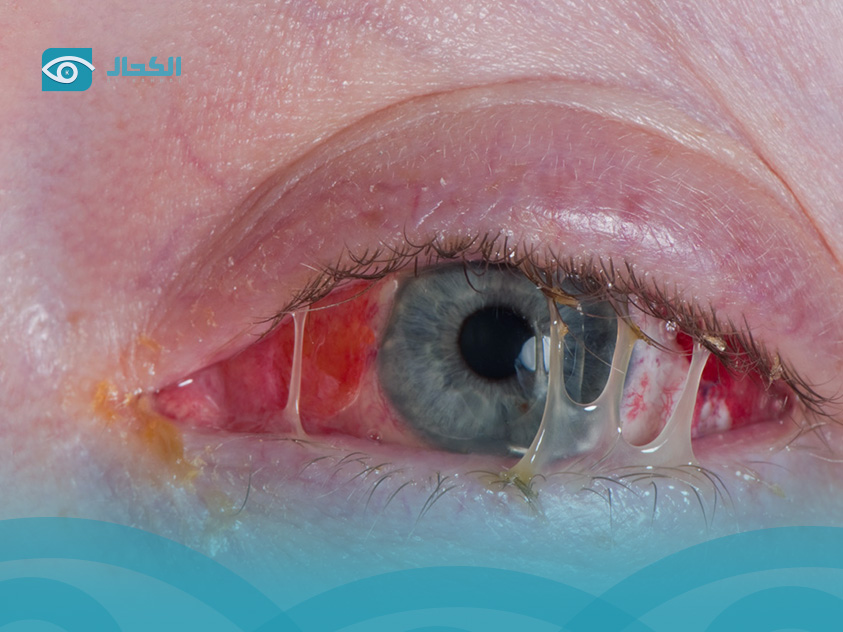 eye-infection-treatment