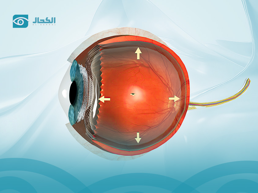 اسباب القرنية المخروطية